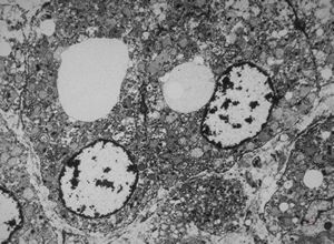 M, | newborn mitochondrial cardiomyopathy … autopsy sample from liver M, | newborn mitochondrial cardiomyopathy … autopsy sample from liver